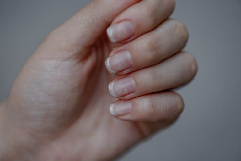 White Spots on Nails: A Sign of Magnesium Deficiency?